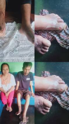 CuplikCom-Kasim-Menderita-Pembengkakan-Kaki-Butuh-Bantuan-Pemerintah-08062022230528-IMG-20220608-WA0056.jpg